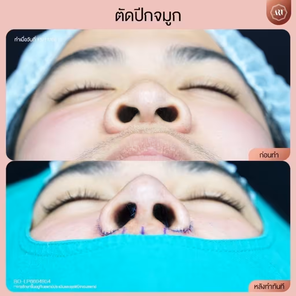 ตัดปีกจมูกหน้าเปลี่ยนไหม