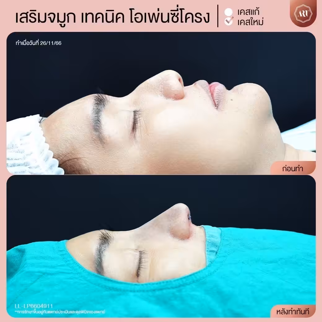 ทำจมูกแบบโอเพ่น