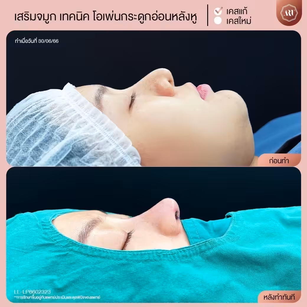 ทำจมูกแบบโอเพ่น กระดูกอ่อนหลังหู