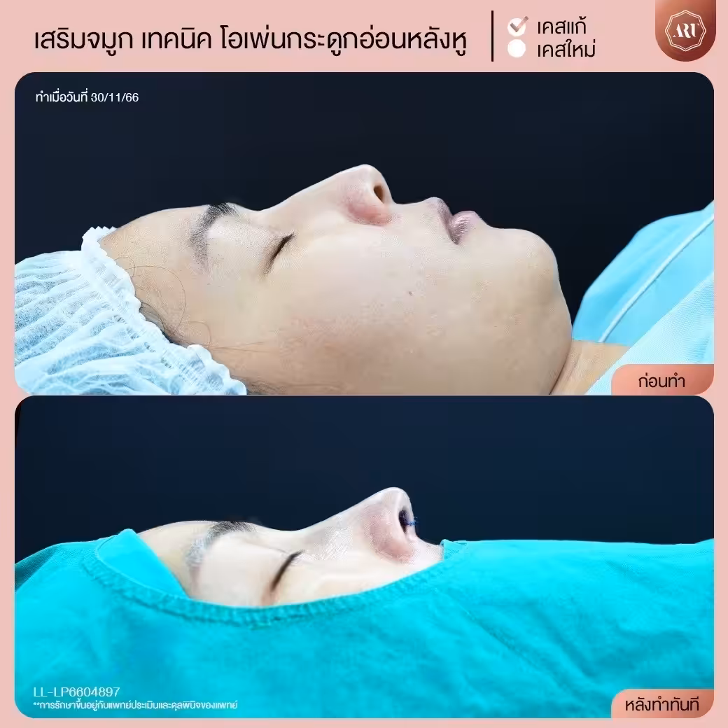 เสริมจมูกแบบโอเพ่น รีวิว