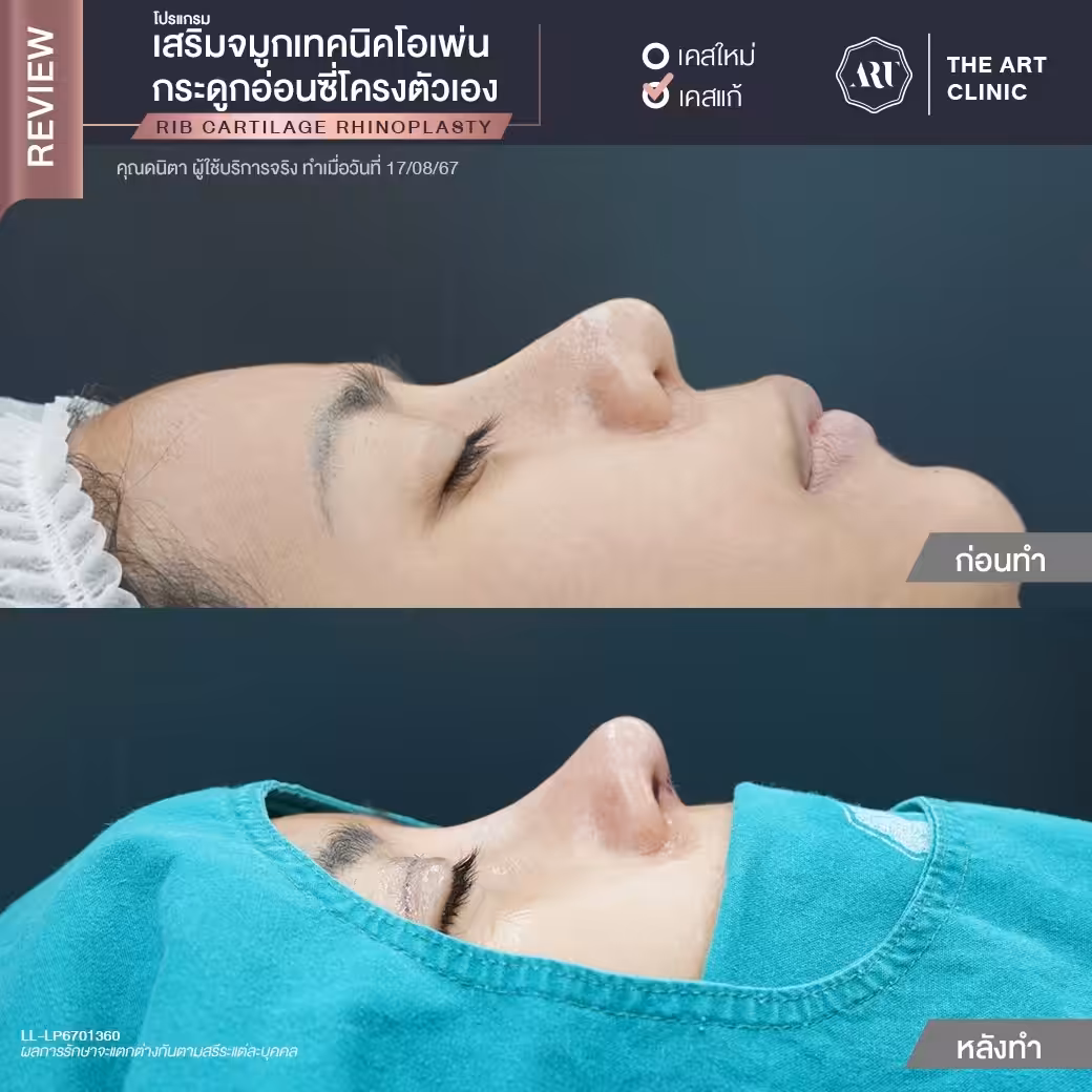 การทําจมูกแบบ open คือ