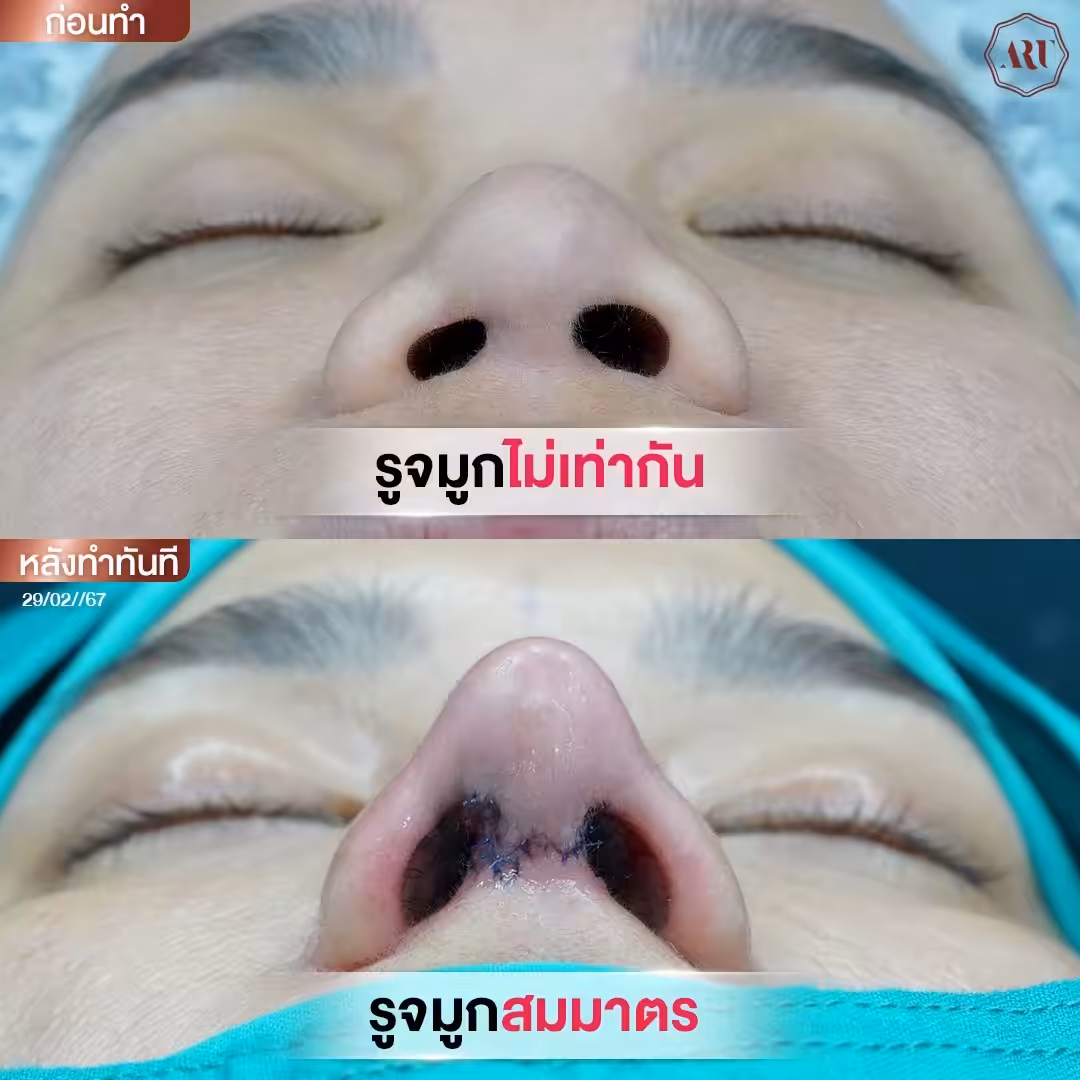จมูกโอเพ่น
