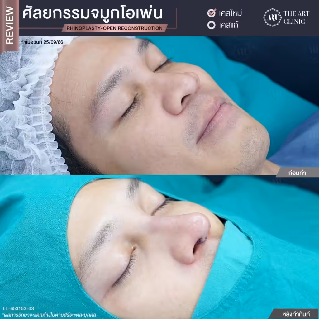 รีวิวจมูกโอเพ่น