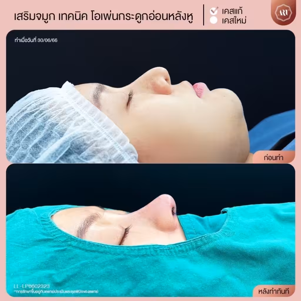 รีวิวเสริมจมูกเทคนิค Open