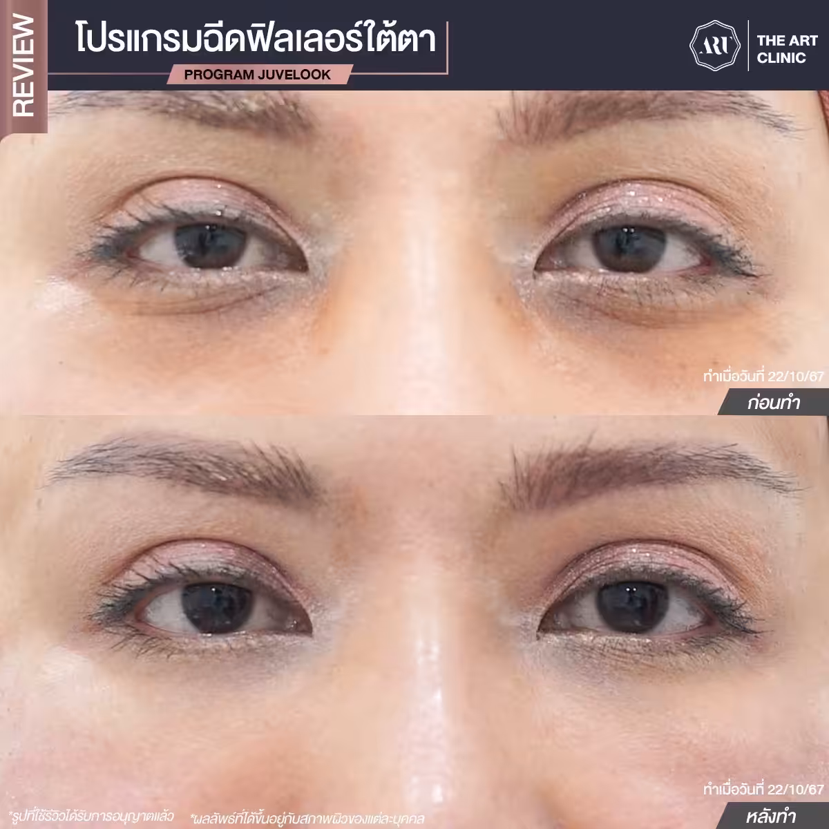 ใต้ตาดำ