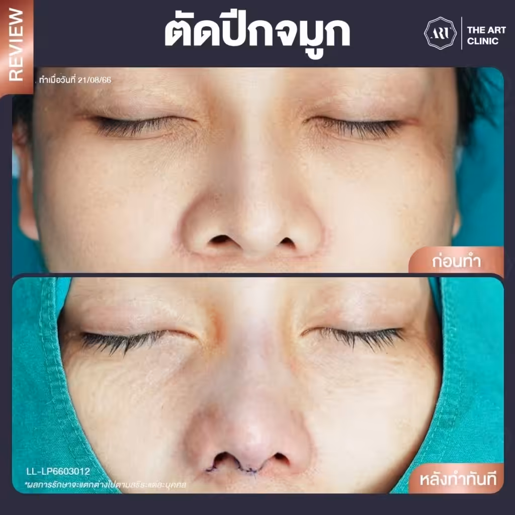 ตัดปีกจมูกที่ The Art