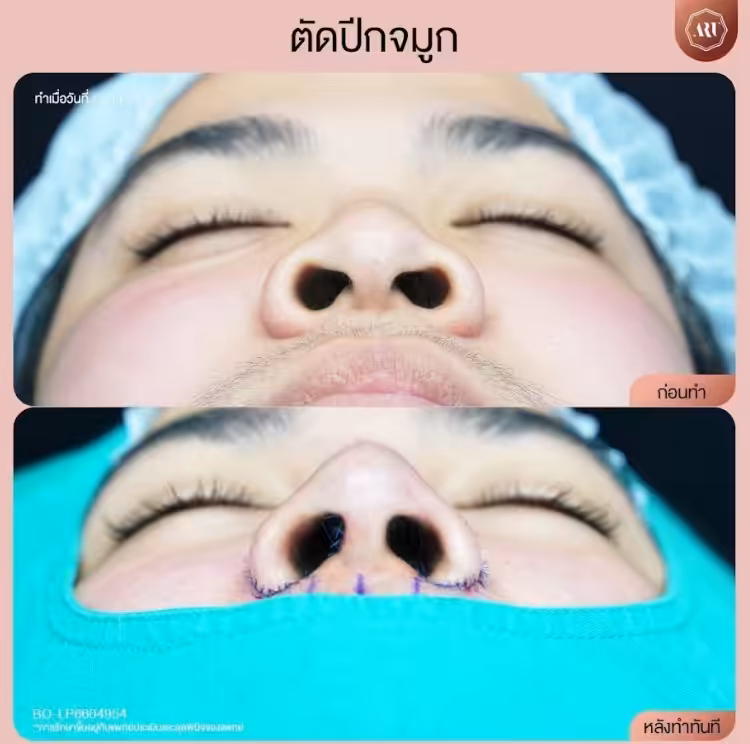 แผลตัดปีกจมูกกี่วันหาย