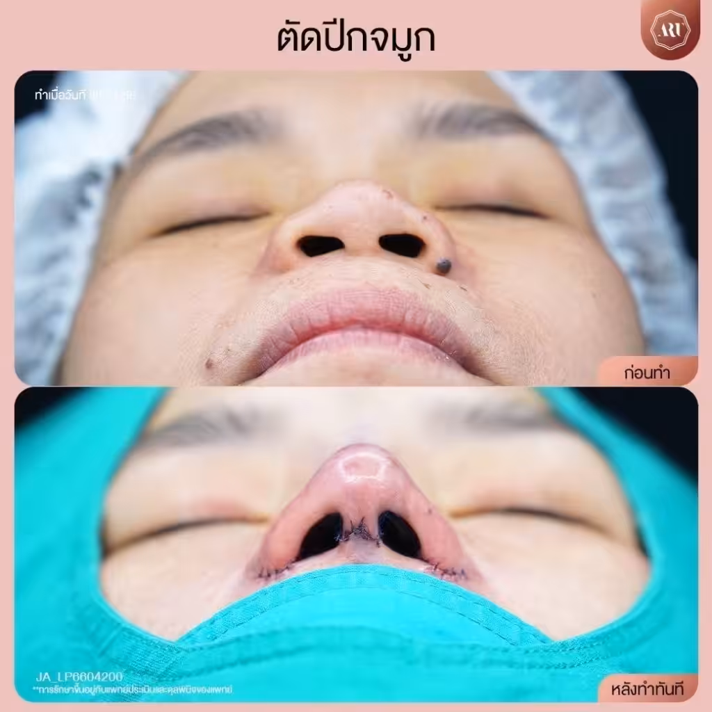 รีวิวตัดปีกจมูกที่ไหนดี