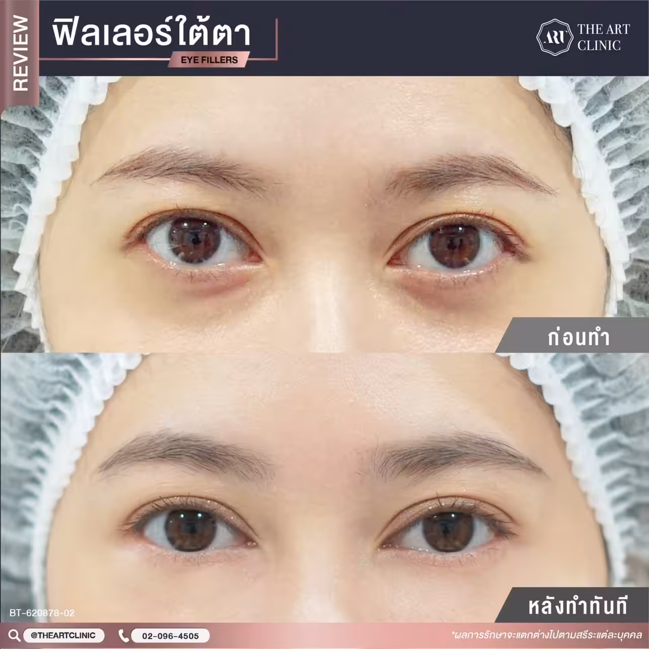 รีวิวฉีดใต้ตา