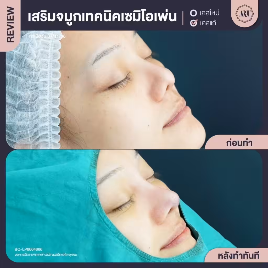 รีวิวคลินิกเสริมจมูก