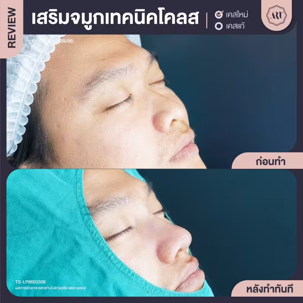 รีวิวเสริมจมูกเนื้อน้อย