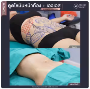ดูดไขมันเอวเอส