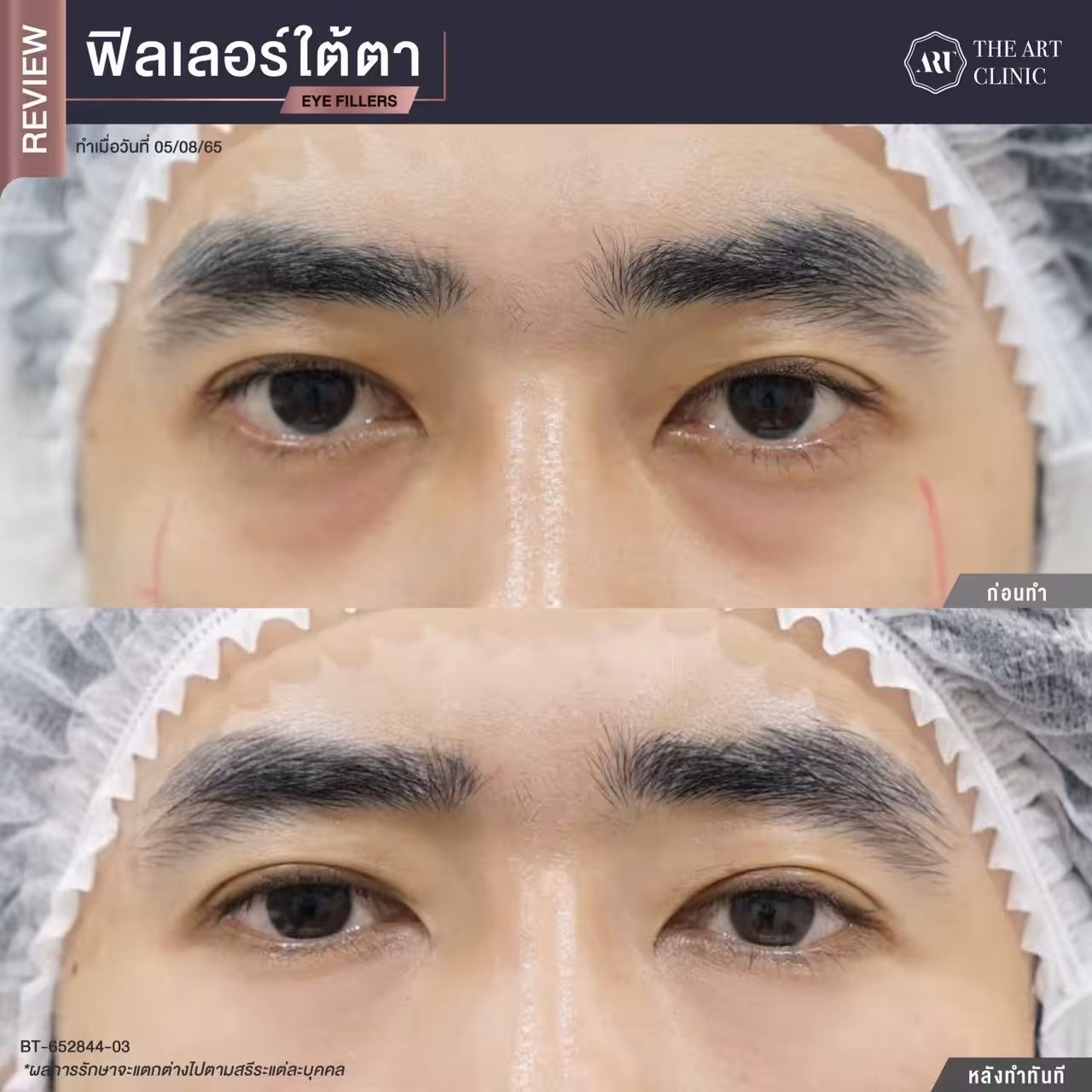 ใต้ตาหย่อนคล้อย