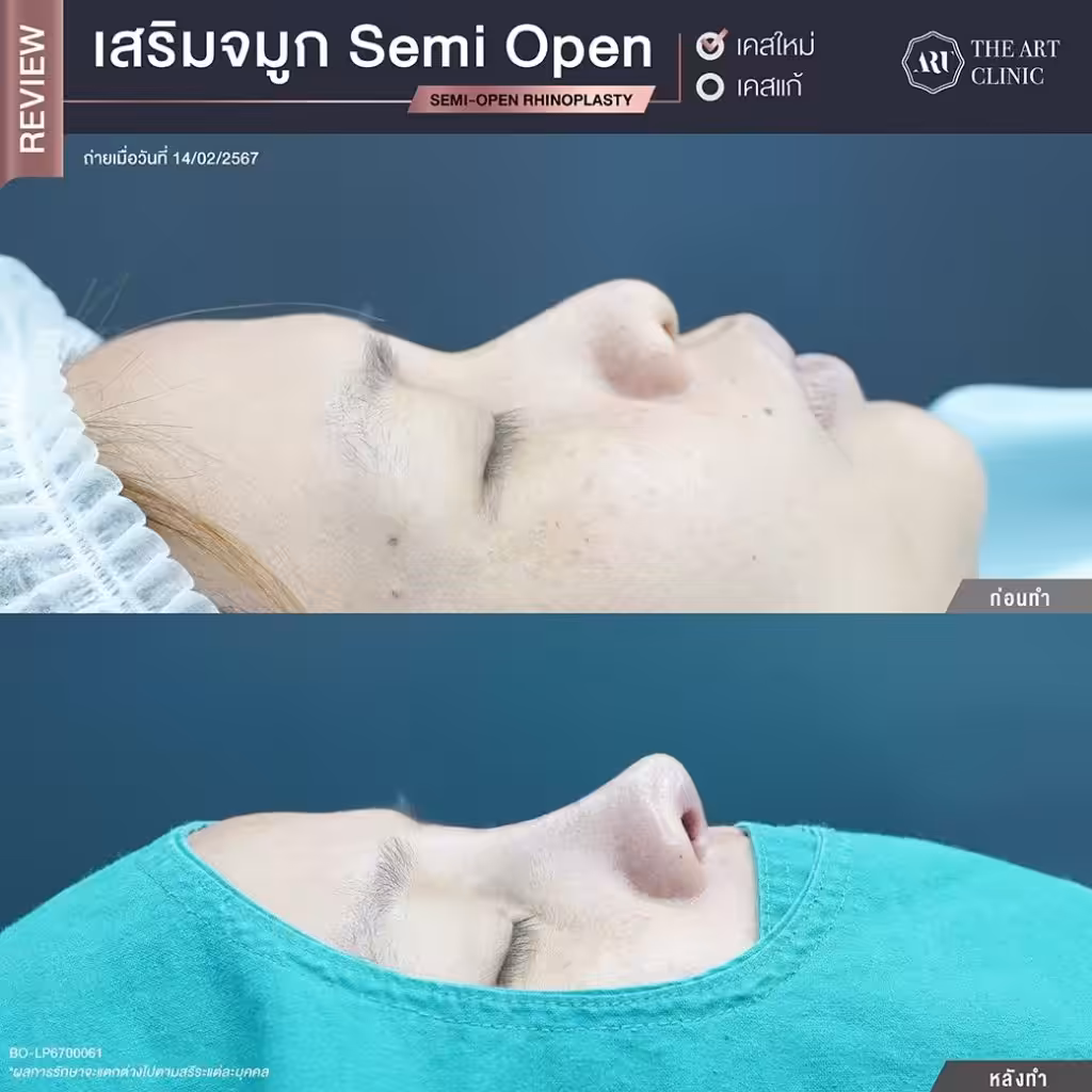 เสริมจมูกแบบเซมิโอเพ่น