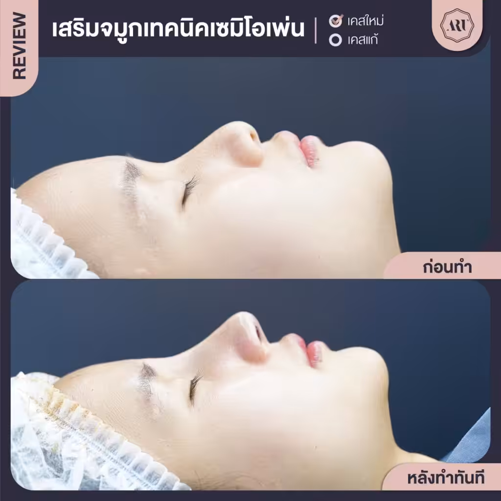 รีวิวเสริมจมูกเทคนิค Semi-Open