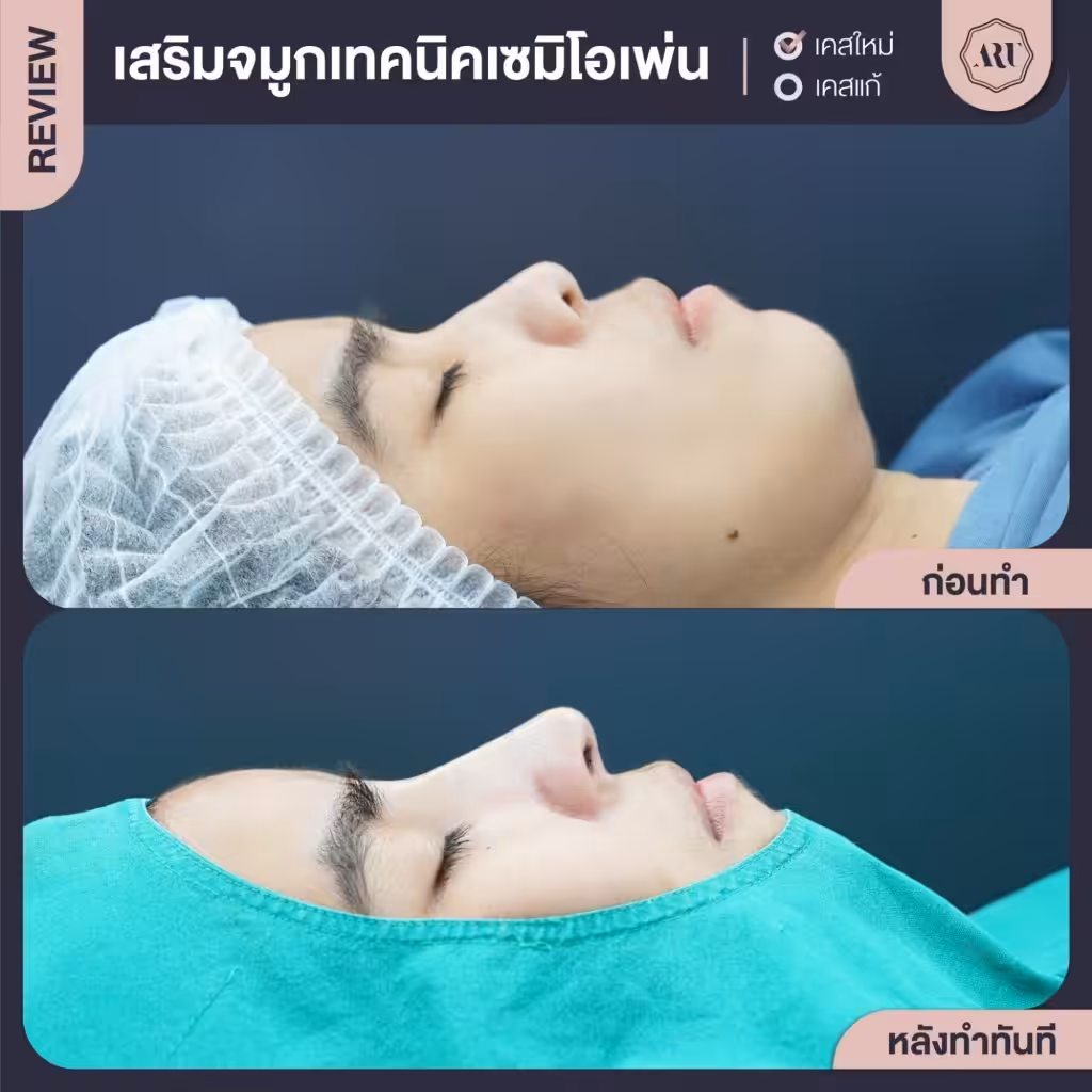 ทรงจมูกสโลปปลายพุ่ง