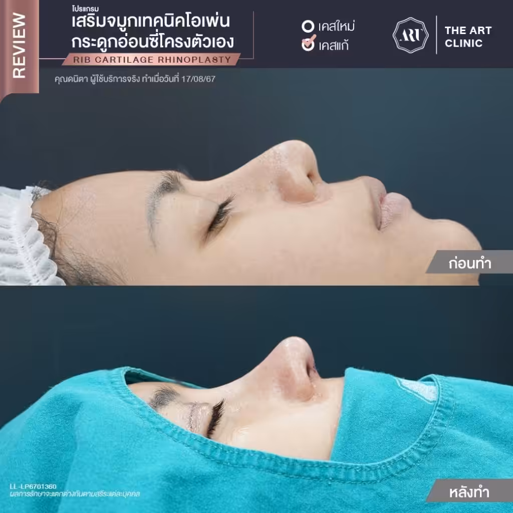 จมูกทรงสโลปปลายเชิด รีวิว