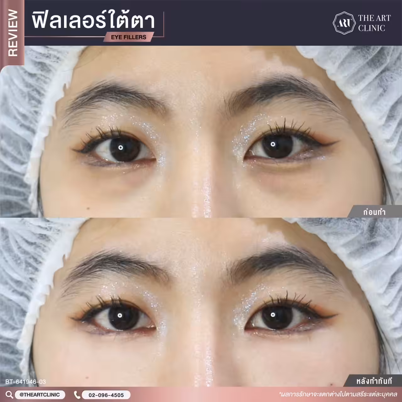 ถุงใต้ตาบวม