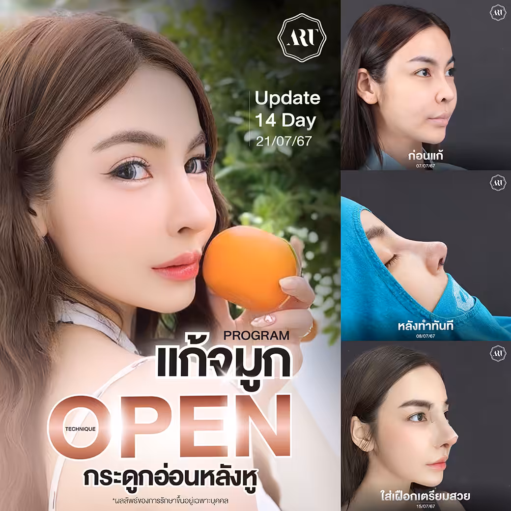 ทําจมูกแบบ open คือ