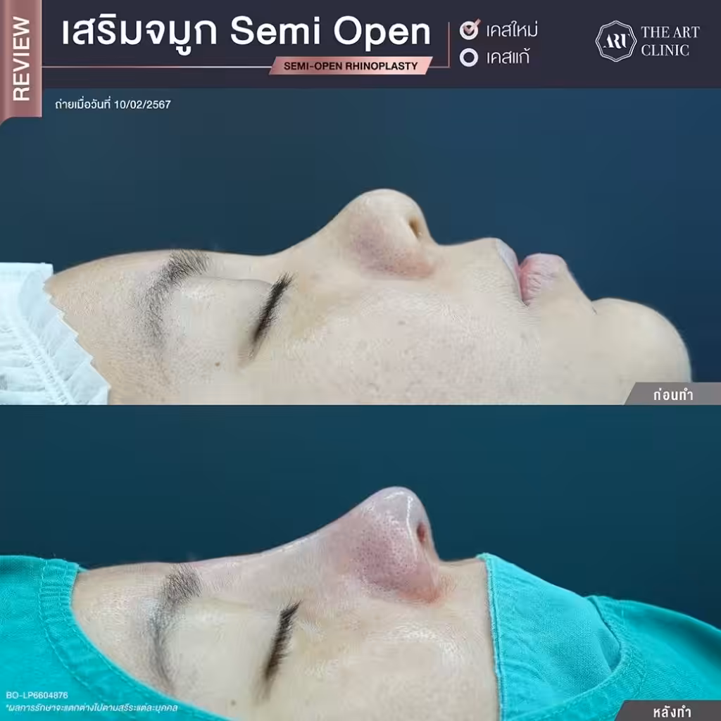 ทำจมูกที่ไหนสวย