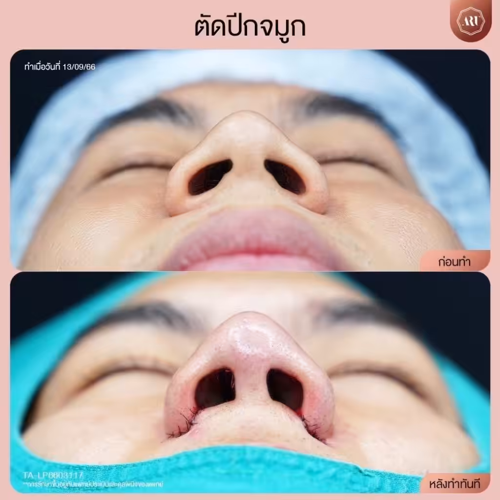 ตัดปีกจมูกที่ไหนดี