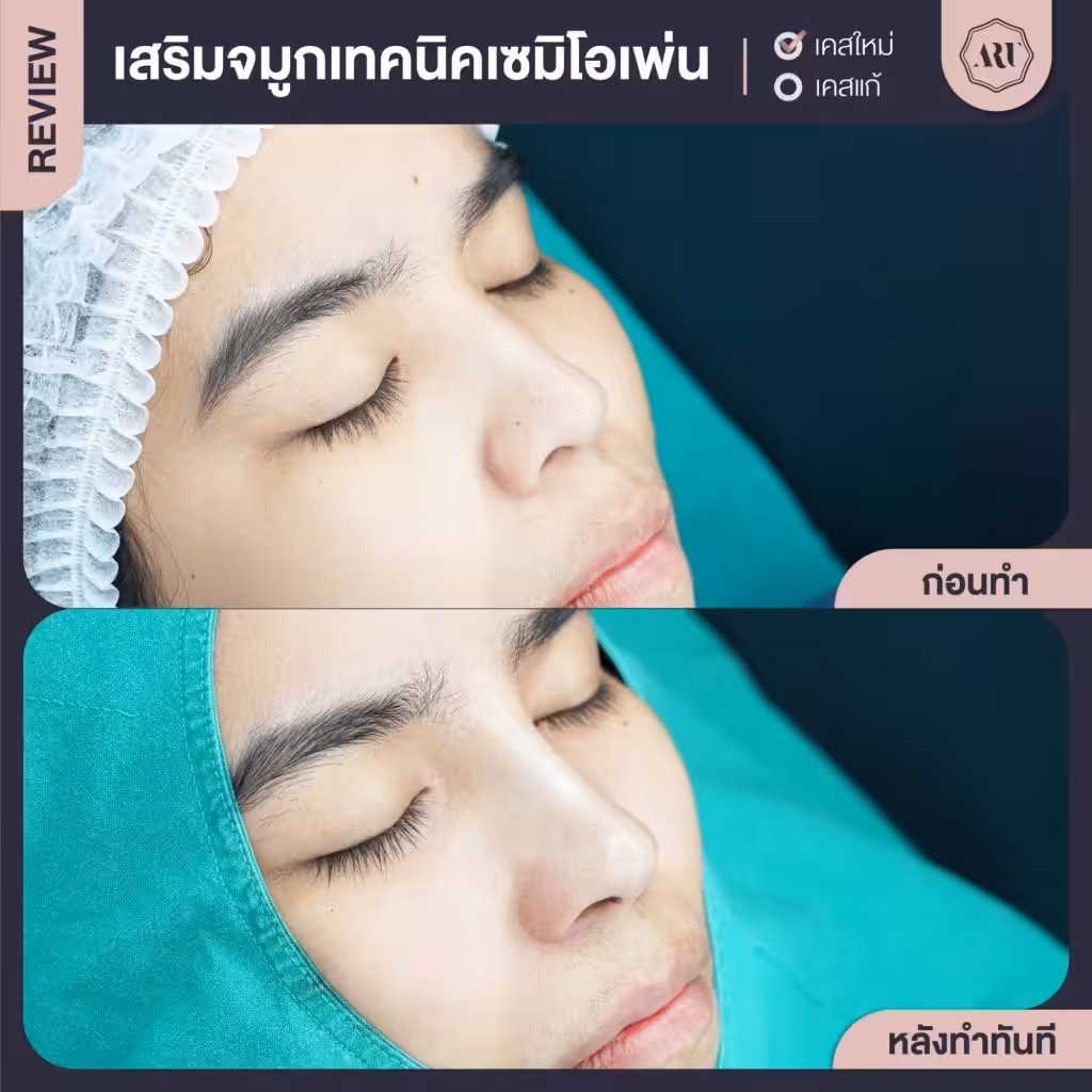 ทำจมูกที่ไหนดี