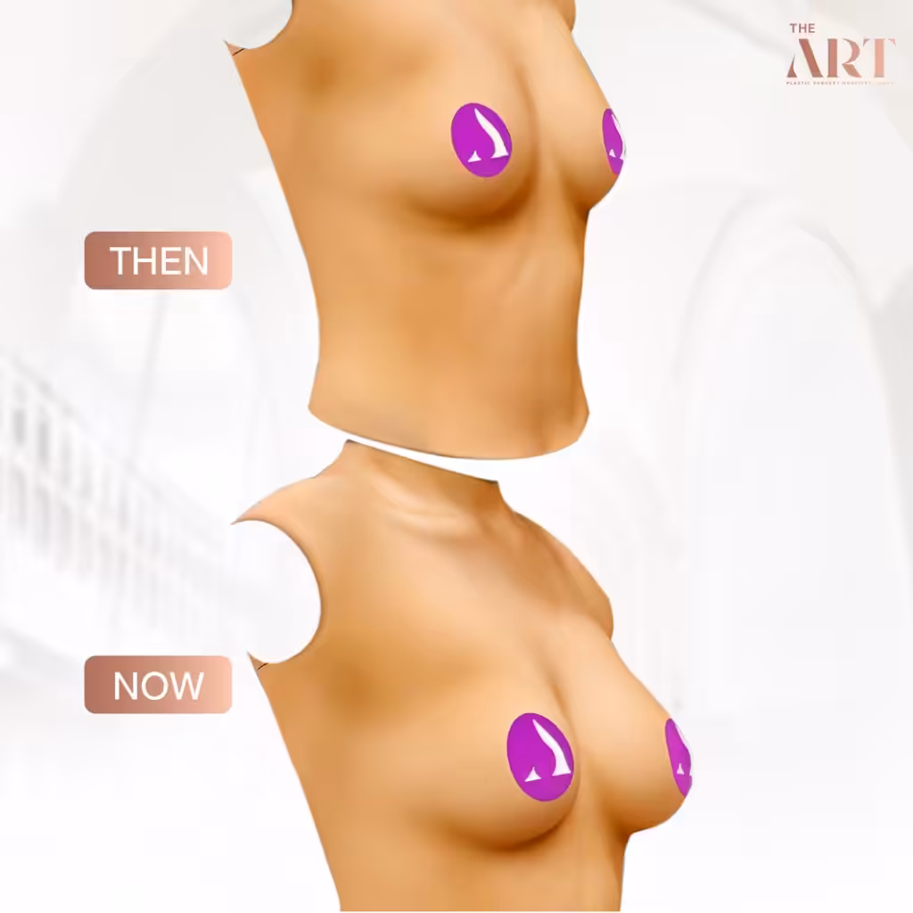 ภาพเปรียบเทียบหน้าอกก่อนและหลังเสริมหน้าอกของคุณเฟิร์น วรางณนา ที่ The Art Clinic