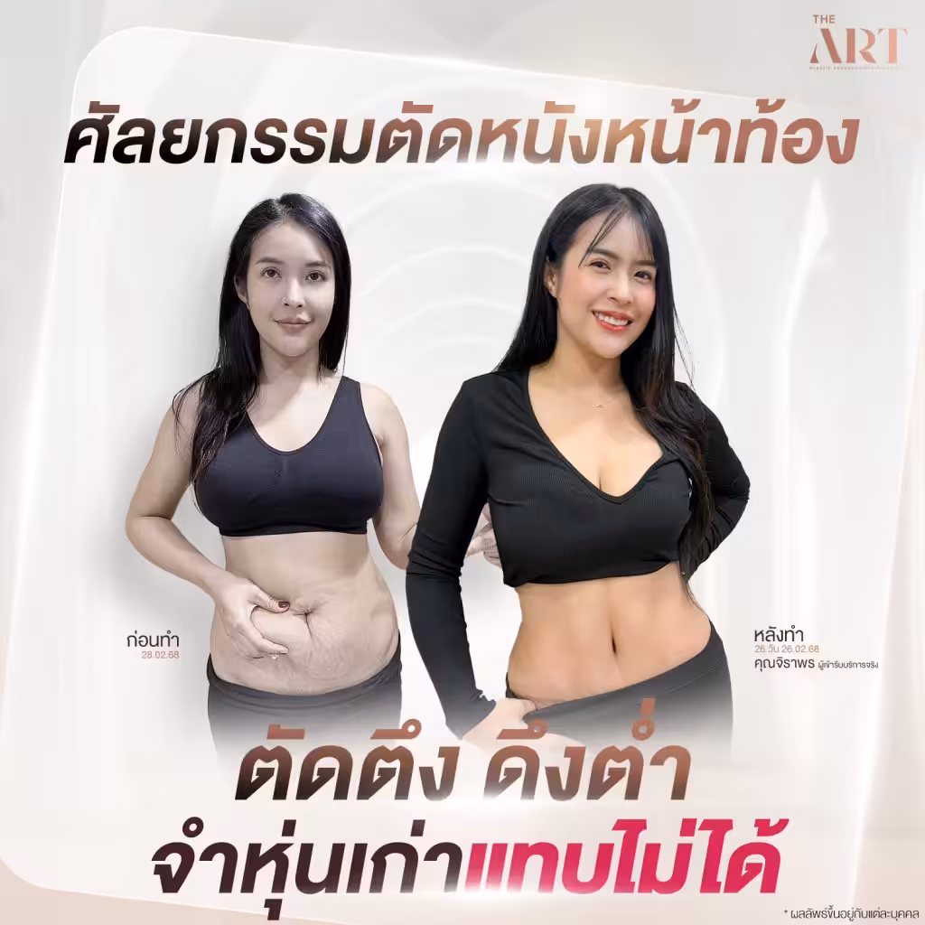 ภาพก่อนและหลังศัลยกรรมตัดหนังหน้าท้องของคุณจิราพร ภาพซ้ายแสดงหน้าท้องหย่อนคล้อยชัดเจน ก่อนทำวันที่ 28.02.68 และภาพขวาแสดงรูปร่างเรียบตึง หลังทำ 26 วัน เปลี่ยนรูปร่างอย่างเห็นได้ชัด พร้อมข้อความ “ตัดตึง ดึงต่ำ จำหุ่นเก่าแทบไม่ได้”