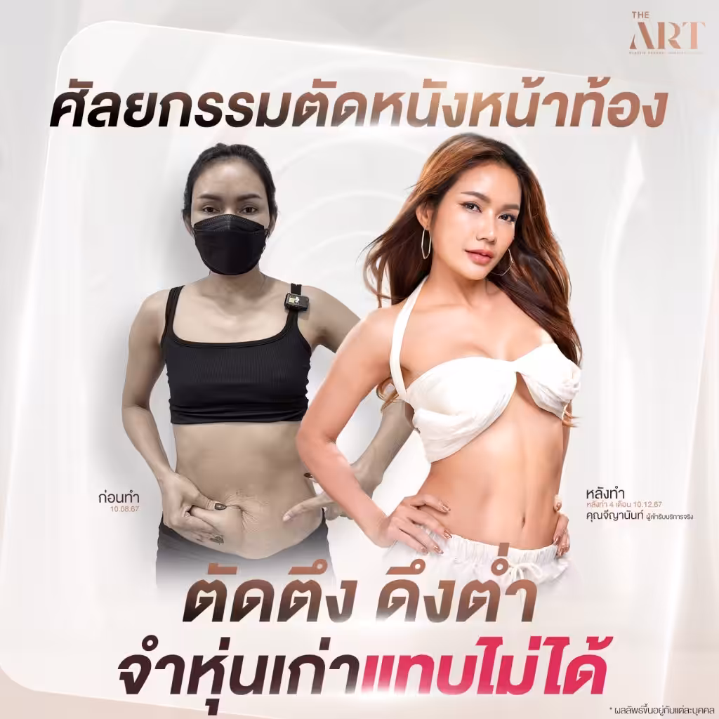 ภาพก่อนและหลังศัลยกรรมตัดหนังหน้าท้องของคุณจีญานันท์ ภาพซ้ายเป็นสภาพหน้าท้องเหี่ยวย่น สวมแมสก์ ก่อนทำวันที่ 10.08.67 ภาพขวาโชว์หน้าท้องเรียบเนียนและมี Sexy Line หลังทำ 4 เดือน พร้อมข้อความ “ตัดตึง ดึงต่ำ จำหุ่นเก่าแทบไม่ได้”