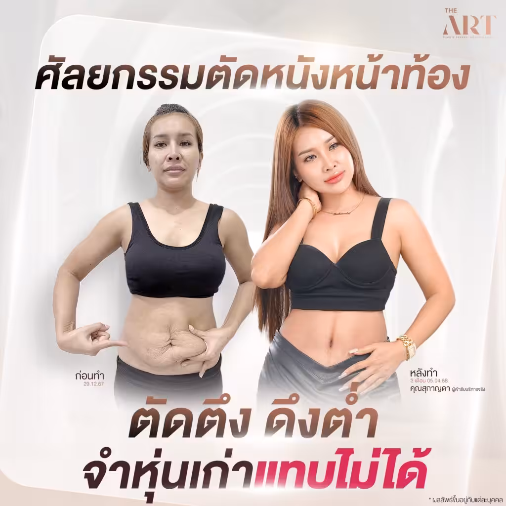 ภาพก่อนและหลังตัดหนังหน้าท้องของคุณสุกาญดา ภาพซ้ายแสดงหน้าท้องหย่อนคล้อยแบบเห็นชัด ก่อนทำวันที่ 29.12.67 และภาพขวาแสดงหุ่นกระชับสวยงาม หลังทำครบ 3 เดือน พร้อมข้อความ “ตัดตึง ดึงต่ำ จำหุ่นเก่าแทบไม่ได้”