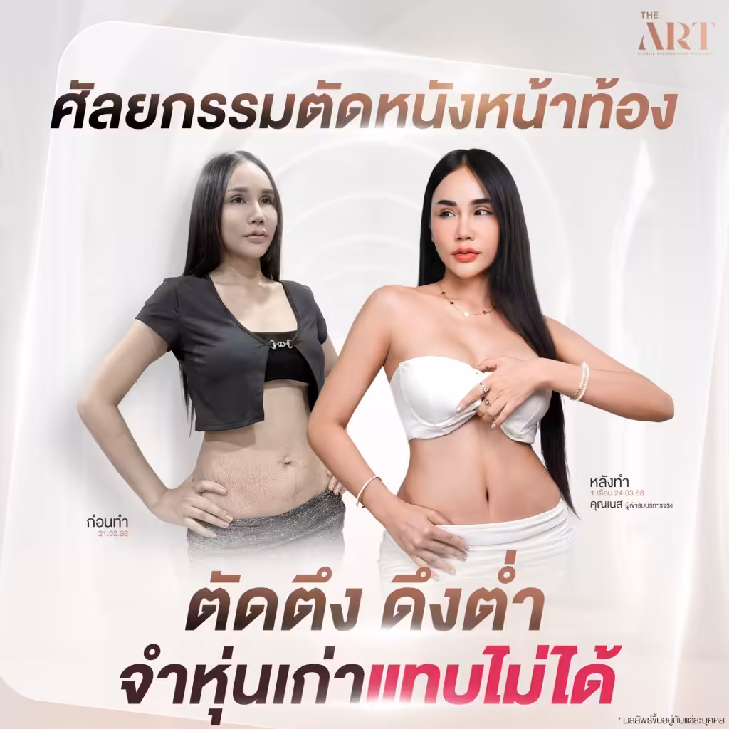ภาพเปรียบเทียบก่อน–หลังตัดหนังหน้าท้องของคุณเนส ภาพซ้ายแสดงหน้าท้องแตกลายและหย่อนคล้อย ก่อนทำวันที่ 21.02.68 และภาพขวาโชว์รูปร่างกระชับพร้อม Sexy Line หลังทำครบ 1 เดือน พร้อมข้อความ “ตัดตึง ดึงต่ำ จำหุ่นเก่าแทบไม่ได้”