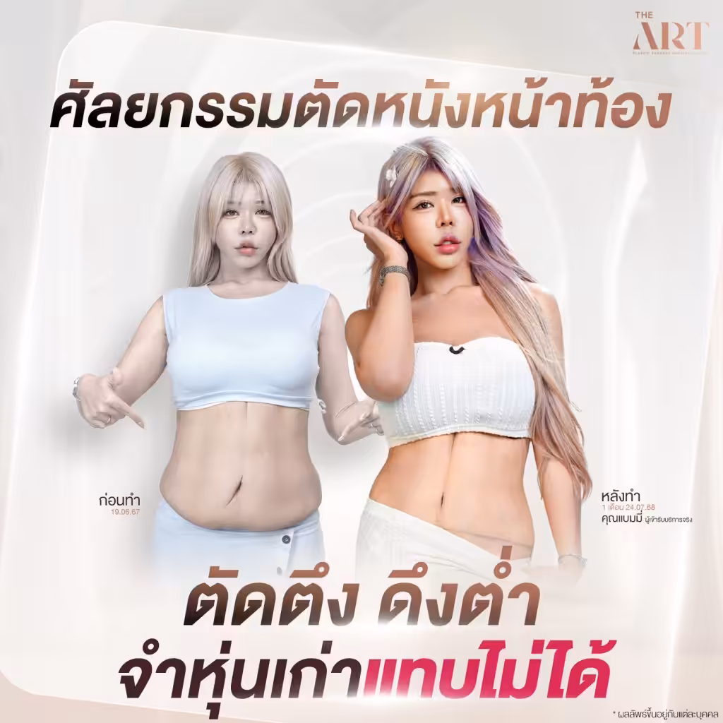 ภาพก่อนและหลังศัลยกรรมตัดหนังหน้าท้องของคุณแบมมี่ ภาพซ้ายแสดงหน้าท้องหย่อนคล้อยมีรอยแตกลาย ก่อนทำวันที่ 19.06.67 และภาพขวาแสดงเอวคอดกระชับ ผิวเนียนใส หลังทำ 1 เดือน พร้อมข้อความ “ตัดตึง ดึงต่ำ จำหุ่นเก่าแทบไม่ได้”