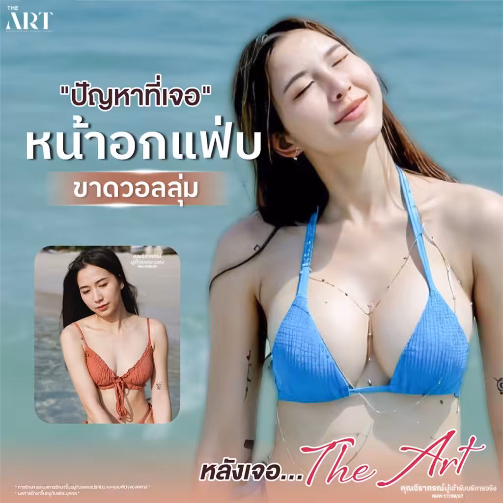 ปัญหาหน้าอกแบน ขาดวอลุ่ม พร้อมภาพก่อนทำจากเคสจริง

