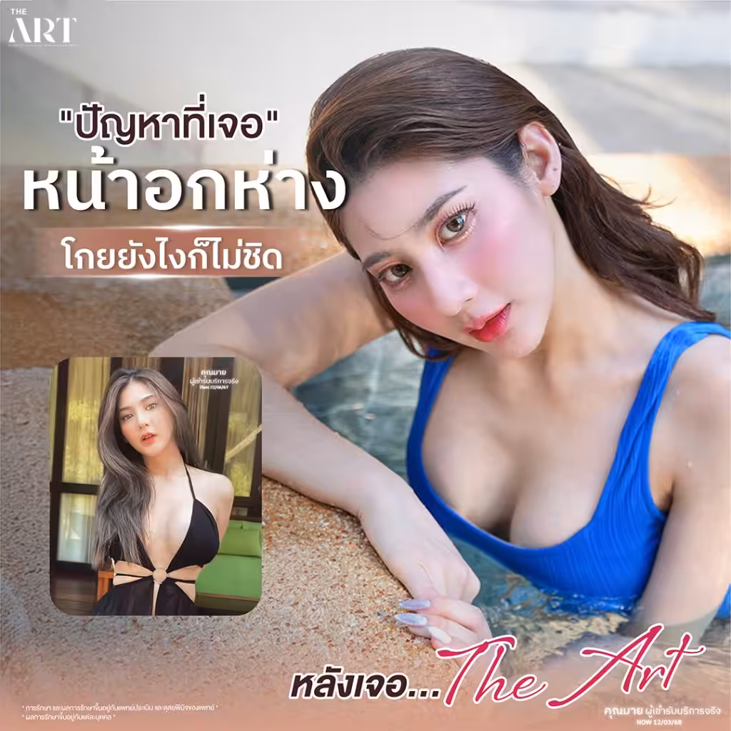 ปัญหาหน้าอกห่าง โกยยังไงก็ไม่ชิด พร้อมภาพก่อนทำจากเคสจริง

