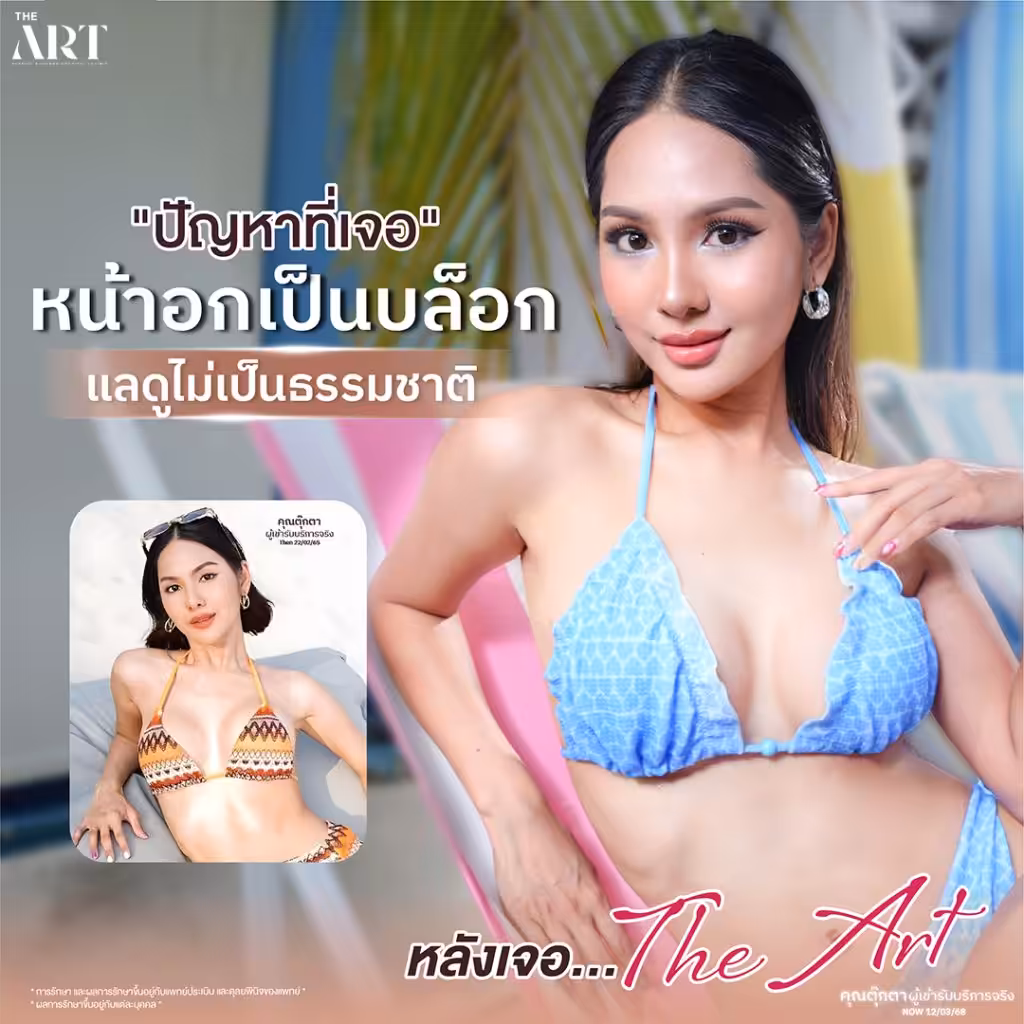 ปัญหาอกหย่อนคล้อย ดูแก่กว่าวัย พร้อมภาพก่อนทำจากเคสจริง