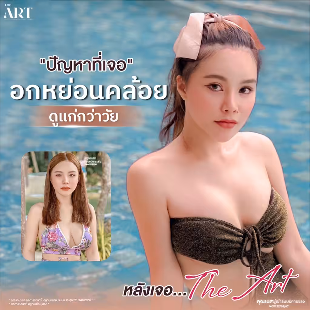 ปัญหาหน้าอกเป็นบล็อก ดูไม่เป็นธรรมชาติ พร้อมภาพก่อนทำจากเคสจริง

