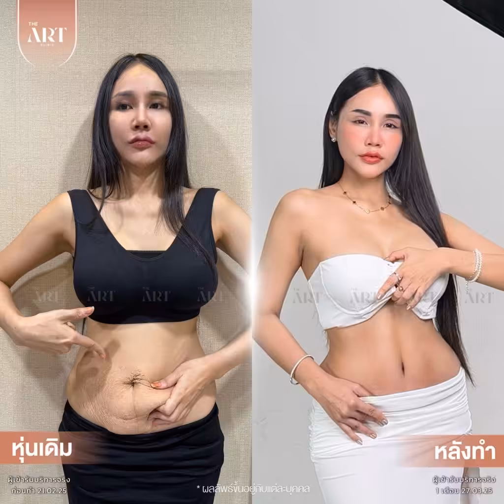 รีวิวตัดหนังหน้าท้อง Before-After เคสจริง หน้าท้องแบน เรียบตึงหลังคลอด ที่ The Art Clinic