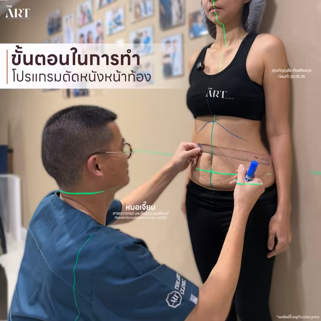 ขั้นตอนการวางแผนก่อนตัดหนังหน้าท้อง โดยหมอเจี๊ยบ ศัลยแพทย์ตกแต่งเฉพาะทางที่ The Art Clinic