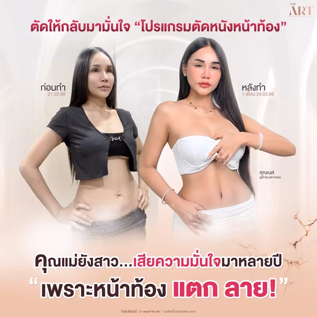 รีวิวตัดหนังหน้าท้องแก้ปัญหาท้องแตกลายหลังคลอด เคสจริงจาก The Art Clinic กลับมามั่นใจอีกครั้ง