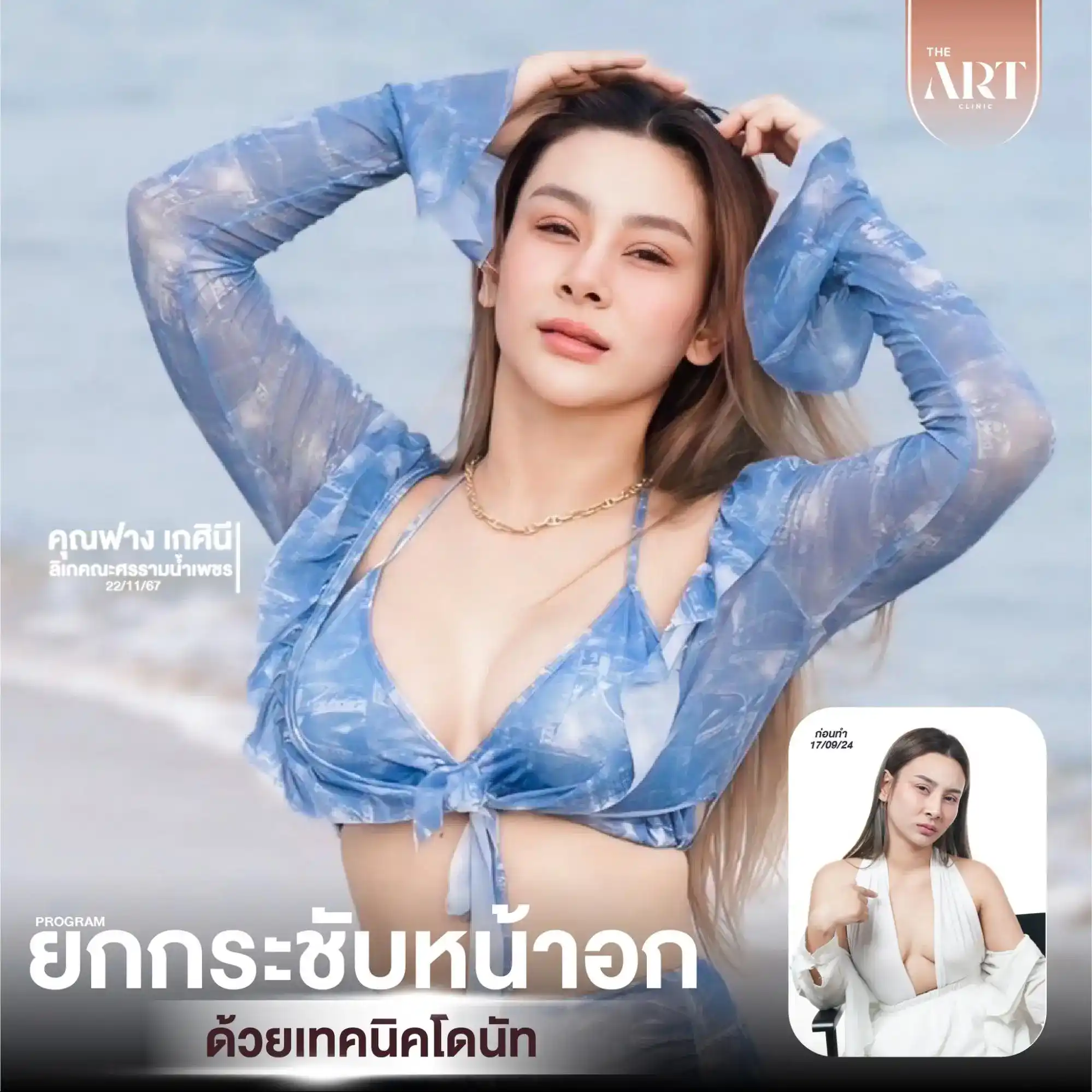 เสริมหน้าอก