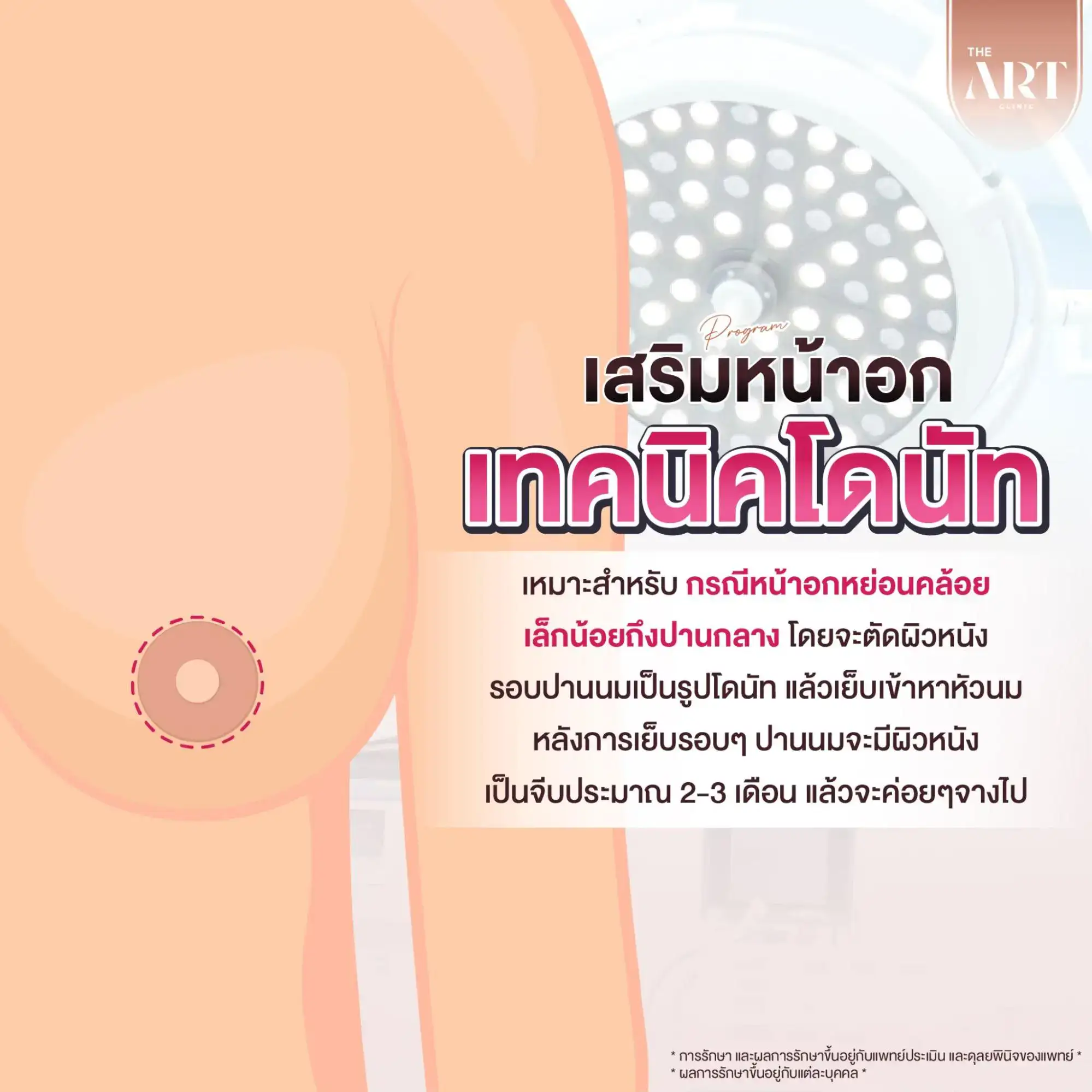 วิธีแก้นมยาน