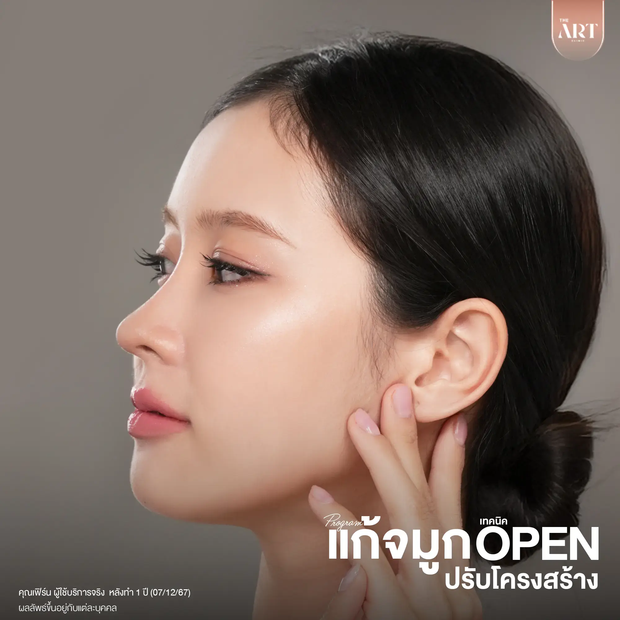 รีวิวเสริมจมูกเนื้อน้อย