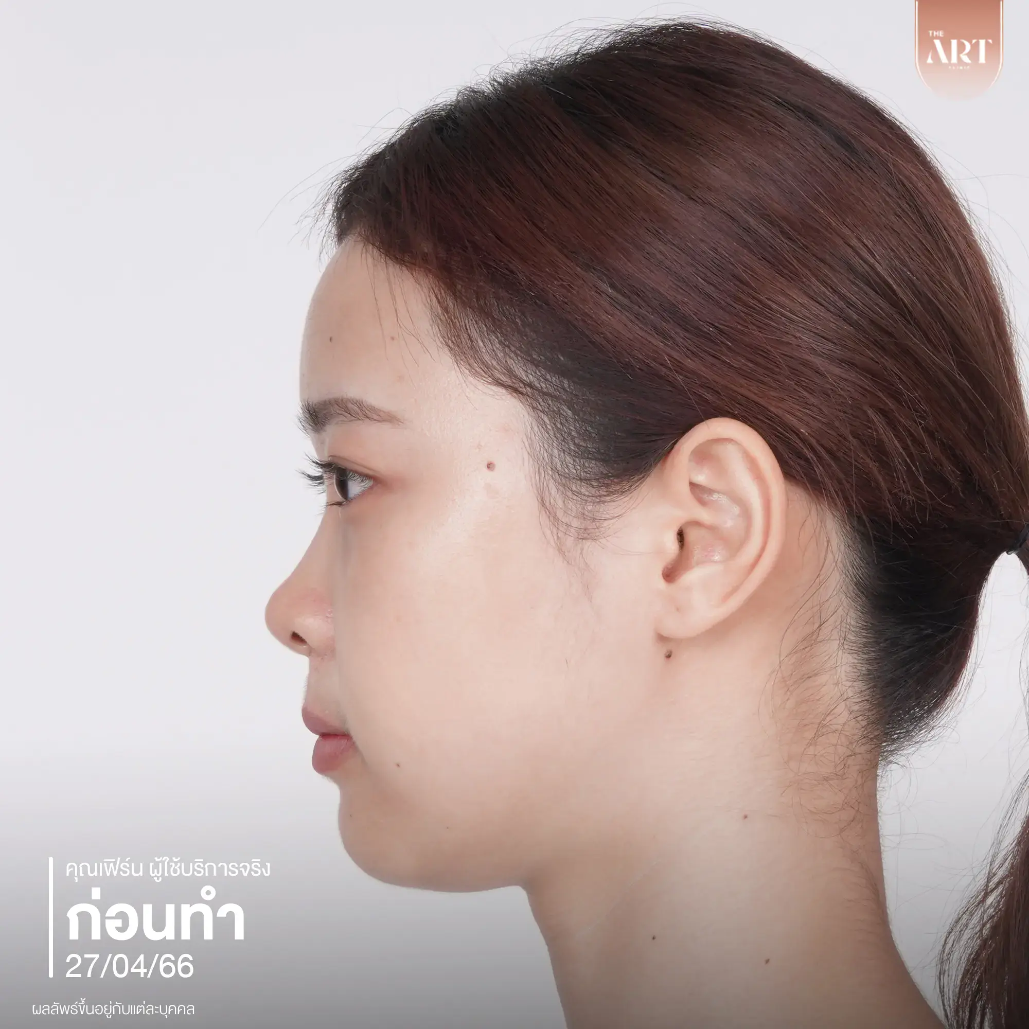 รีวิวก่อนเสริมจมูกเนื้อน้อยมาก