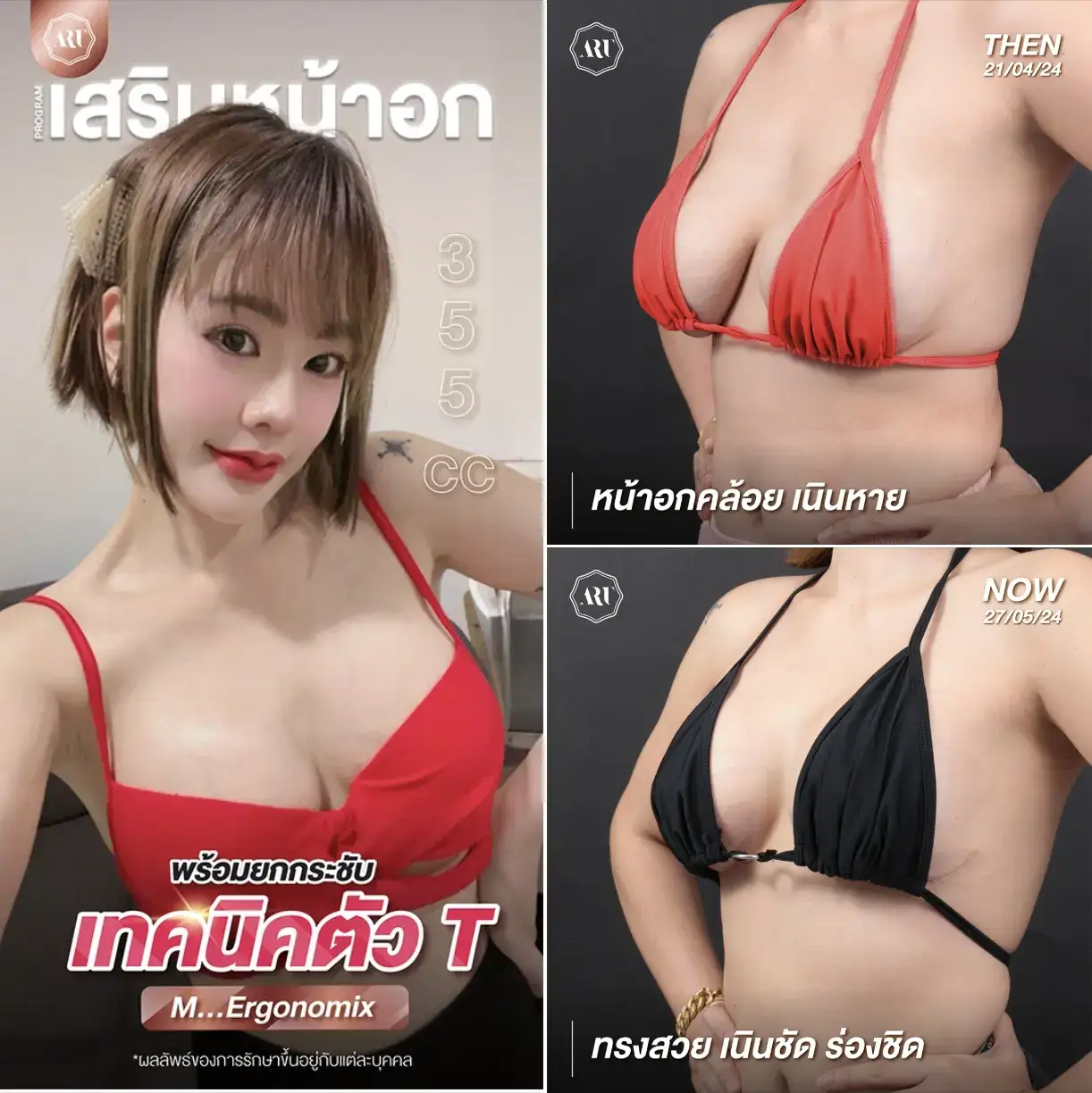 หน้าอกหย่อนคล้อย วิธีแก้