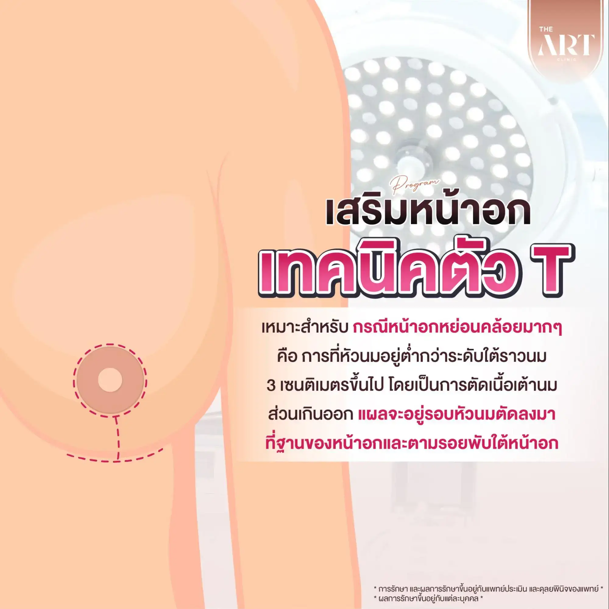 วิธีแก้หน้าอกหย่อนคล้อย