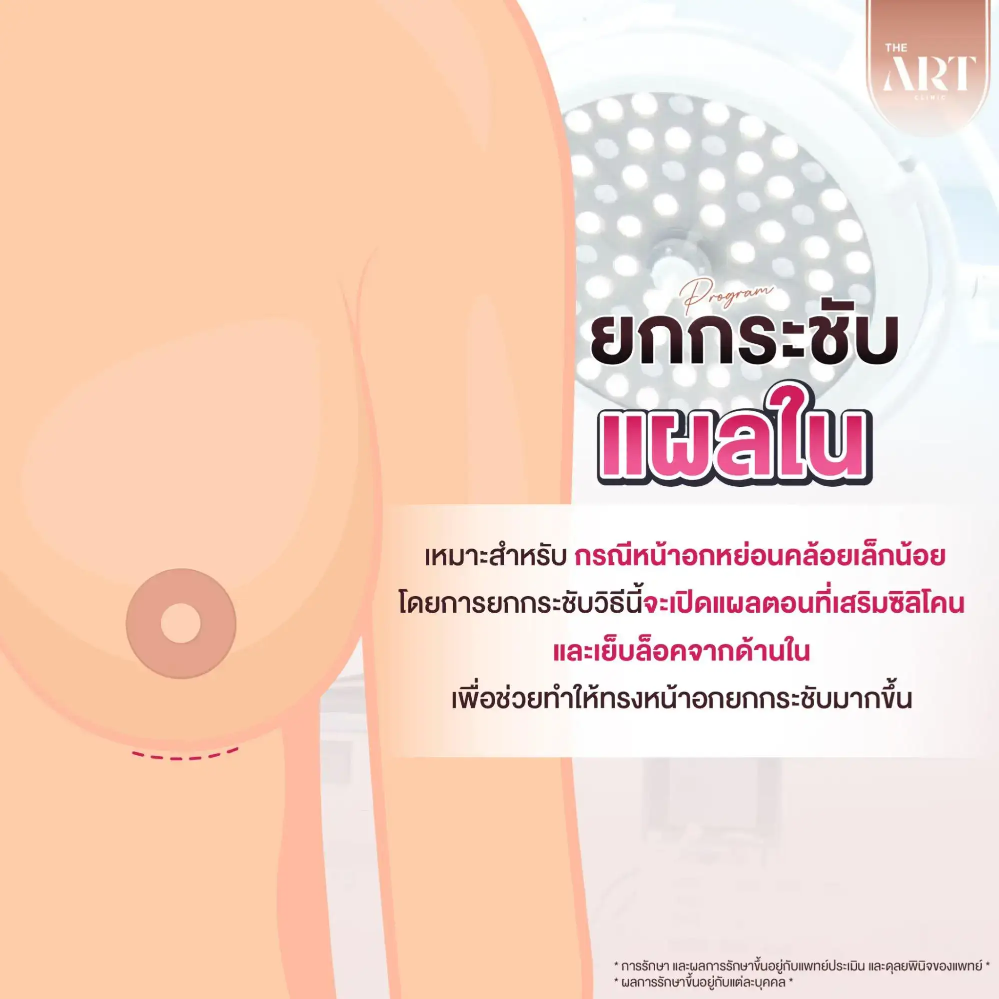 เทคนิคยกกระชับแผลใน (Breast Fix Lift)