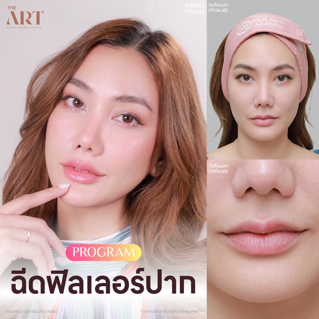 ฟิลเลอร์ปาก-แฟชั่นเช็ต-คุณแพรว.jpg