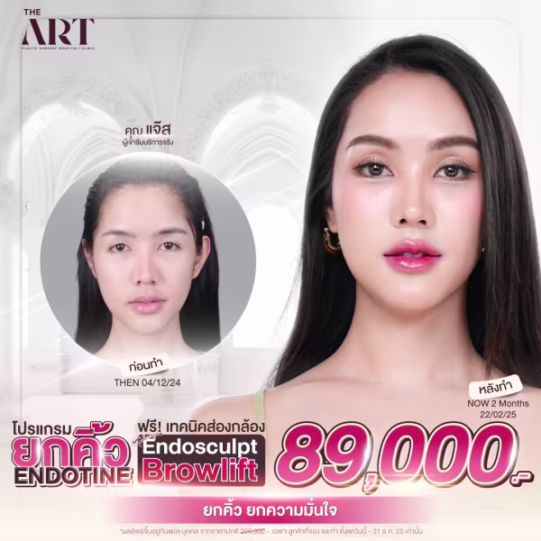 endotine-browlift-endosculpt-camera-technique-promotion-89000-the-art.png