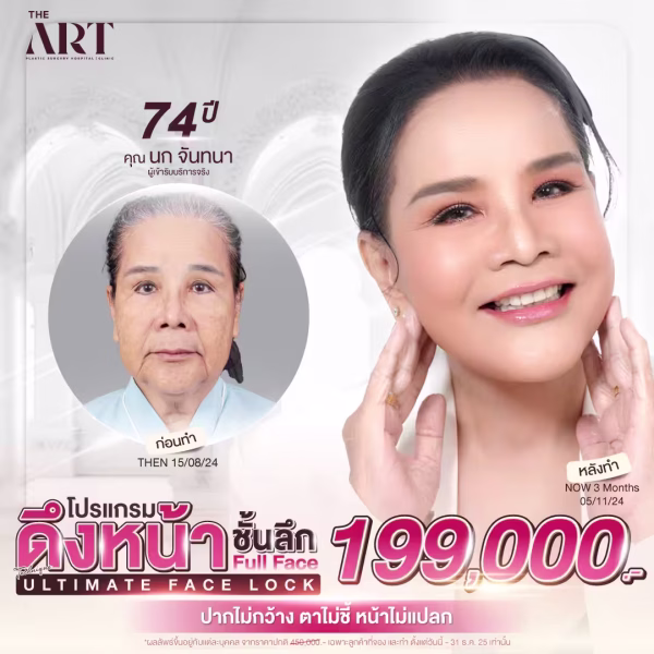 ultimate-face-lock-full-face-lift-promotion-69000-the-art.png
